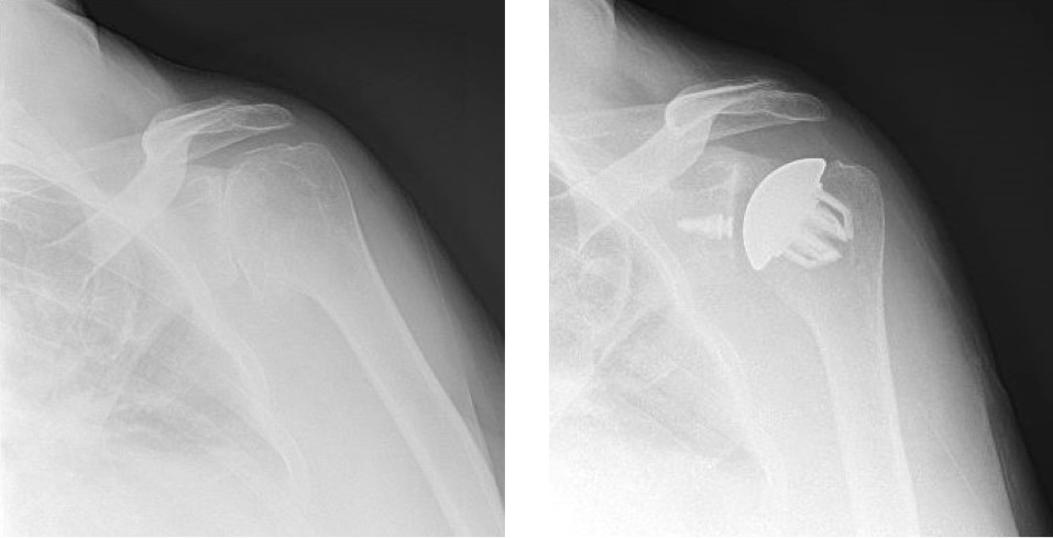 anatomic total shoulder